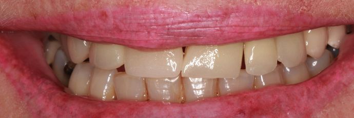 Before dental bridge